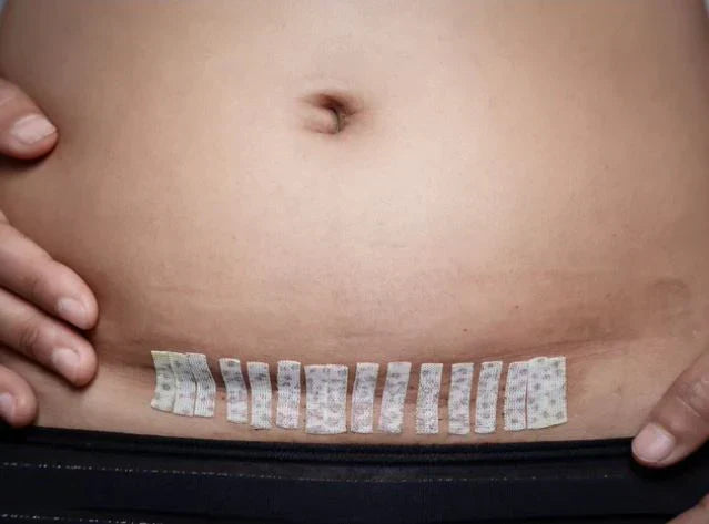 À quoi s’attendre après un accouchement par césarienne